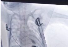 Balloon atrioseptostomy